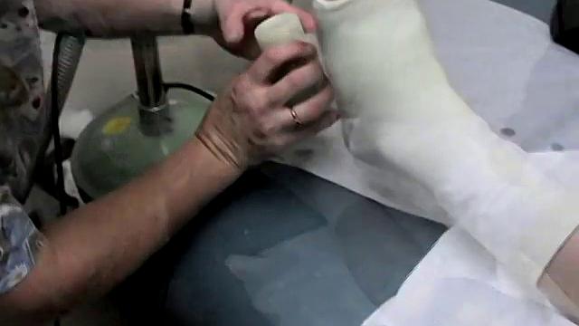 Foot Cast for Evan in Need - Evan Heinze and Ian Madrox