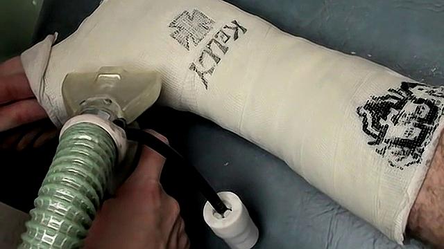 Foot Cast for Evan in Need - Featuring Evan Heinze and Ian Madrox