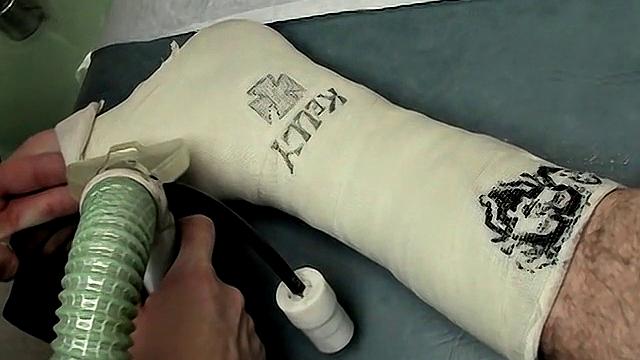 Evan Heinze Gets Foot Cast with Ian Madrox